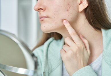 Co to jest trądzik młodzieńczy i jak go leczyć?